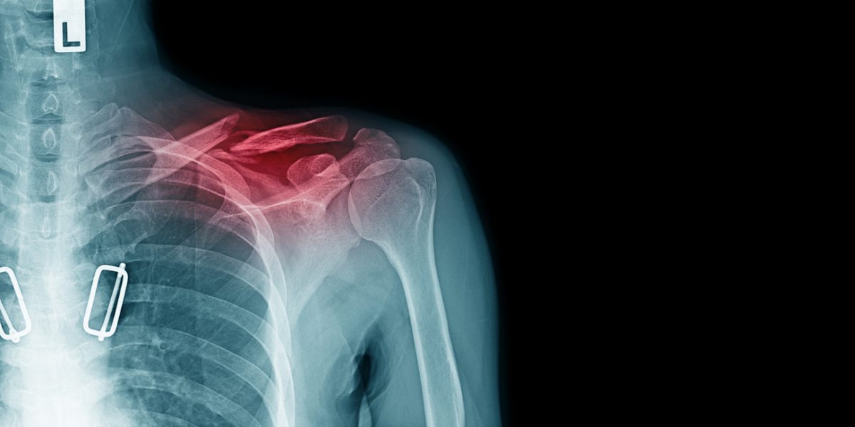 Is Surgical Treatment for a Clavicle Fracture Necessary?