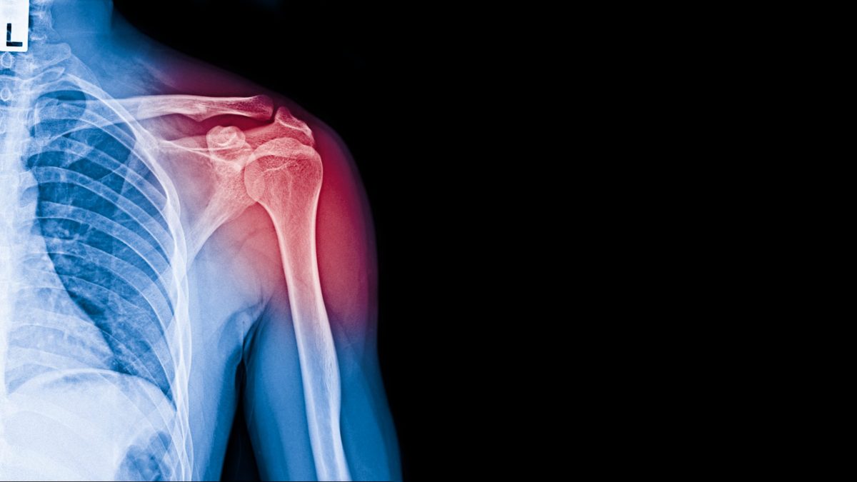  An X-ray image with an injured shoulder highlighted red on a black background. 