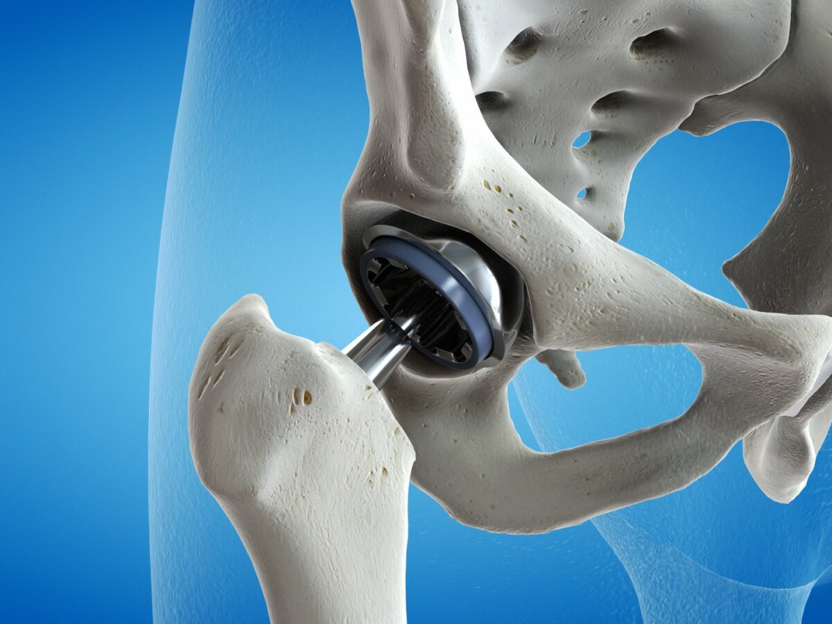 An illustration for joint replacement shows leg and pelvis bones with an artificial hip joint.