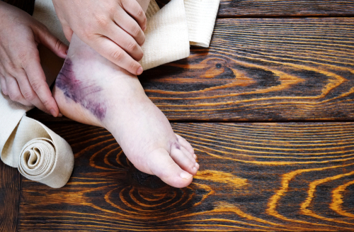 A pair of hands holds a dislocated ankle that is badly bruised and swollen, preparing to be wrapped for immobilization.