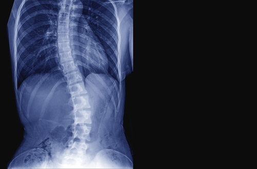 An X-ray of a female’s torso demonstrates the presence of curvature of the spine, indicating the condition scoliosis.
