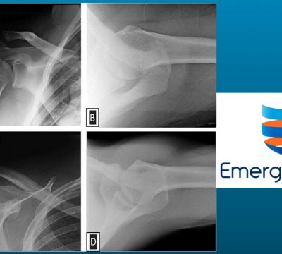 EmergeOrtho Physicians Publish Study in Journal of Shoulder and Elbow Surgery