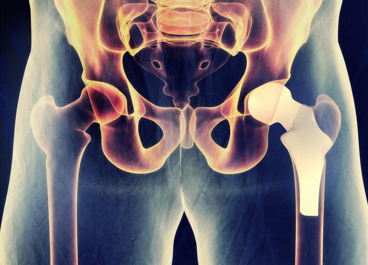 An X-ray displays a hip with a hip replacement on the right hip.
