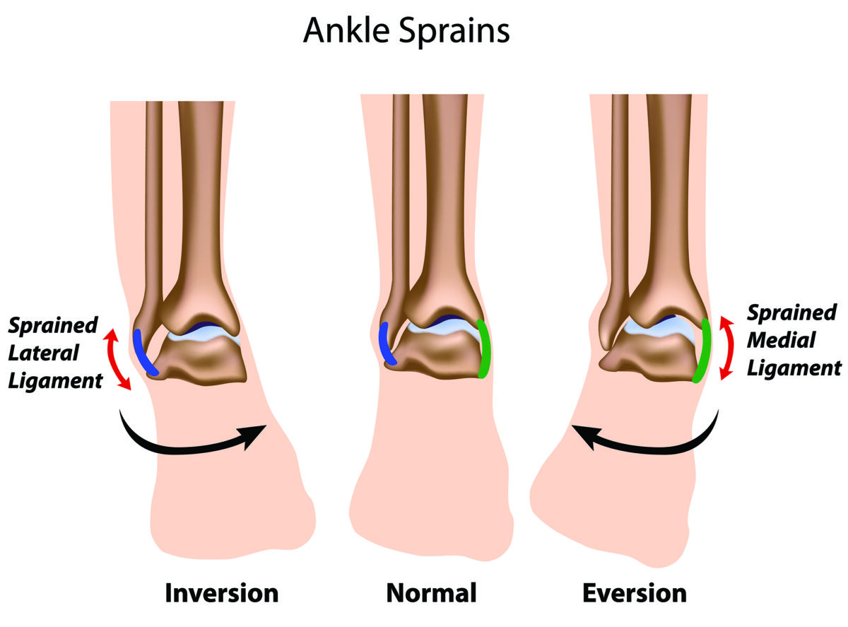 Tips to Shorten Your Ankle Sprain Recovery