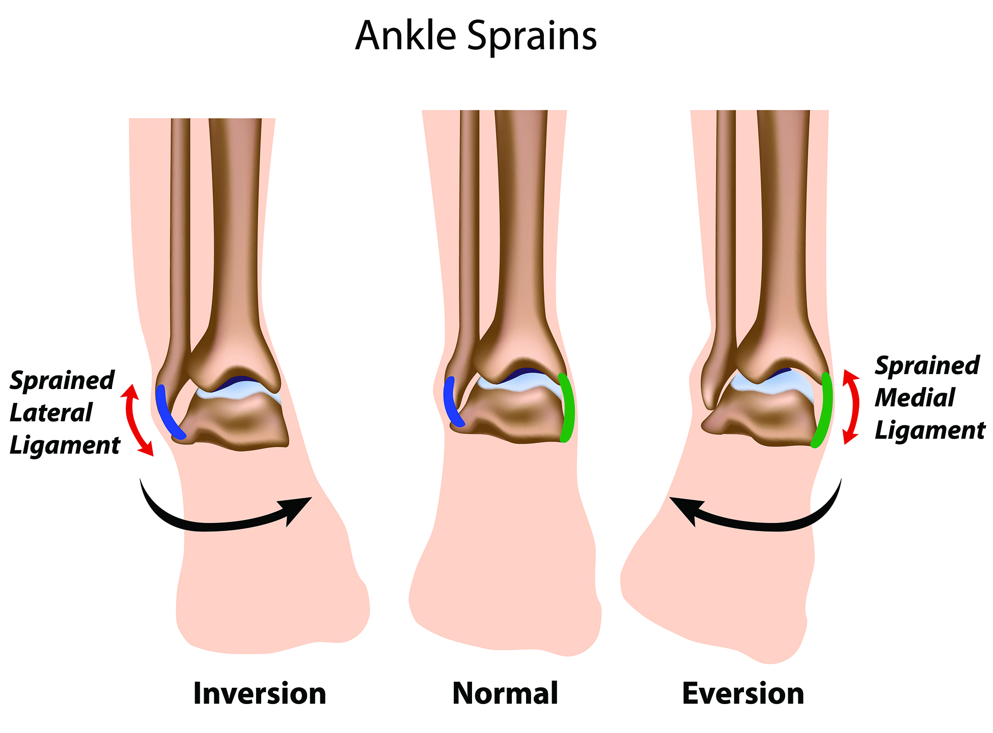 I Sprained My Ankle, What Do I Do? Part 2: P — Return to Play Elite