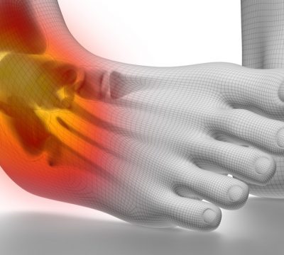 How to Avoid Chronic Ankle Pain after a Sprain