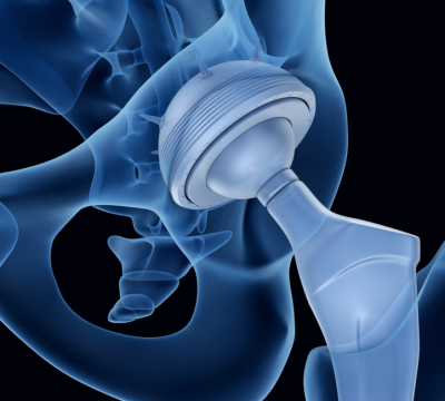 Choosing a Total Joint Replacement Surgeon