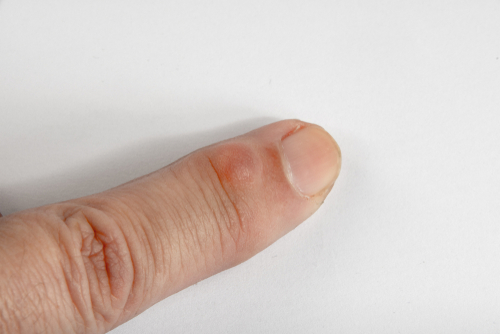 An index finger is pictured with a small round, reddish ganglion cyst near the fingernail bed. 