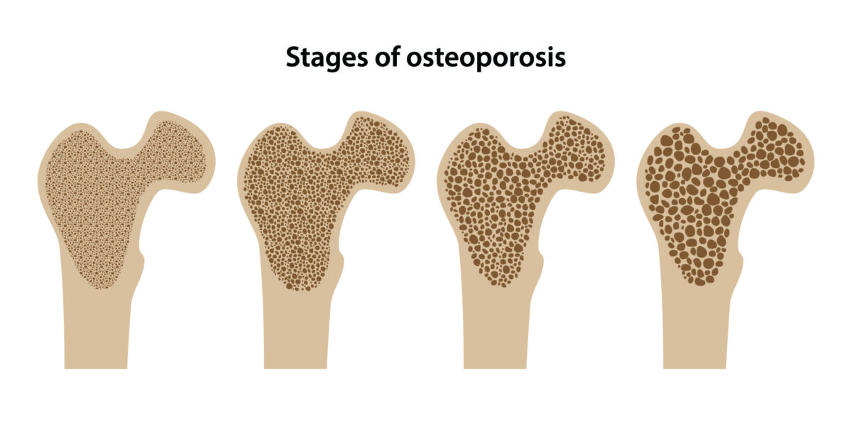 Diagram of a cross-section of bone showing the progression of osteoporosis. 