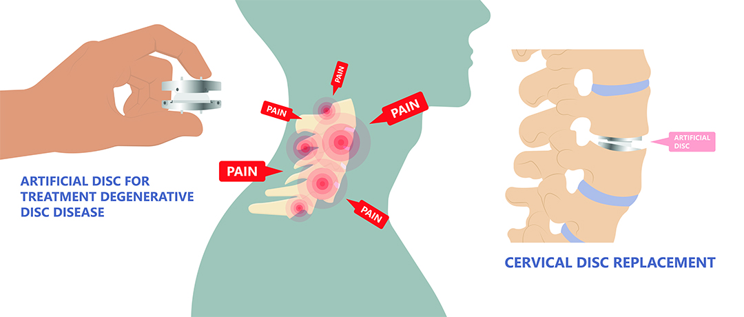  A diagram of an artificial cervical disc replacement to reduce neck pain. 