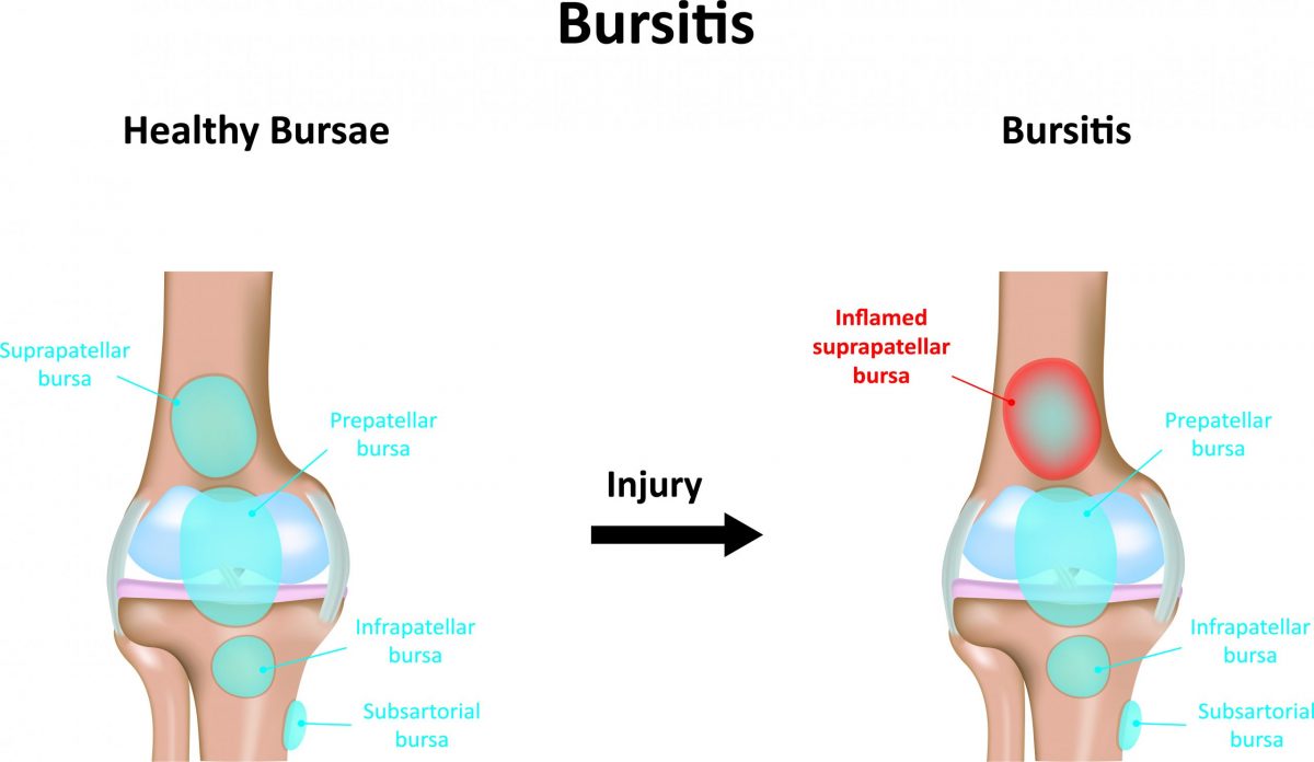 A digital drawing comparison of a healthy bursae in a joint compared to a joint with bursitis. 