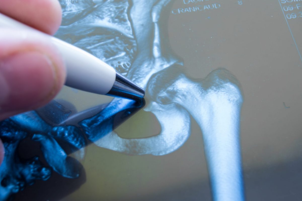  Doctor points to hip xray with sharpie marker. 
