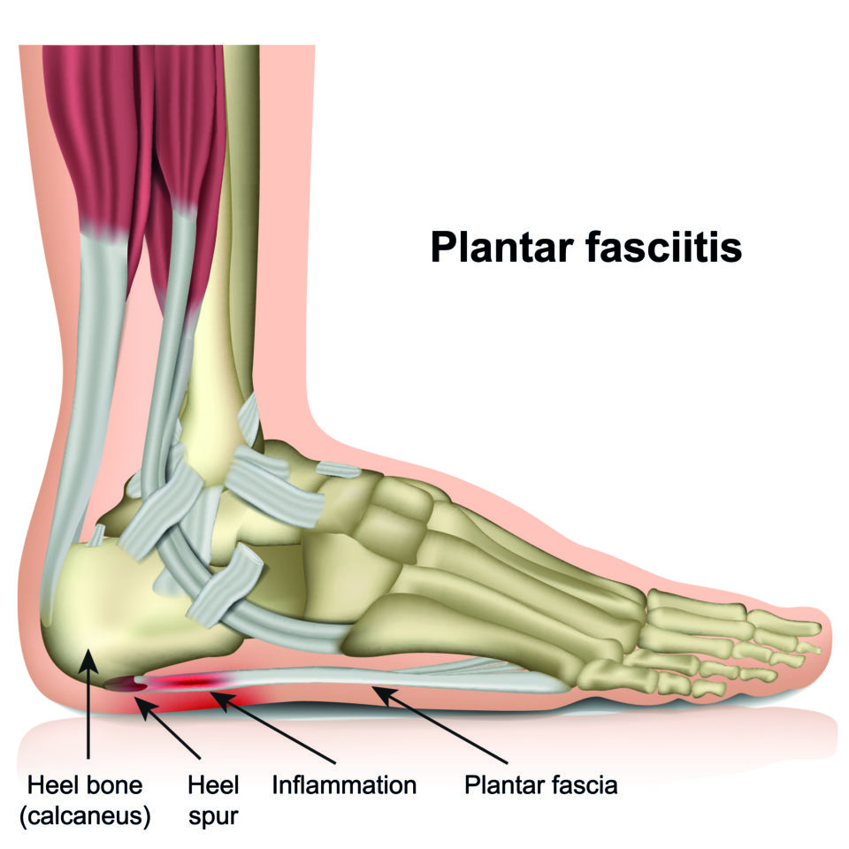 A diagram of plantar fasciitis in an adult foot.