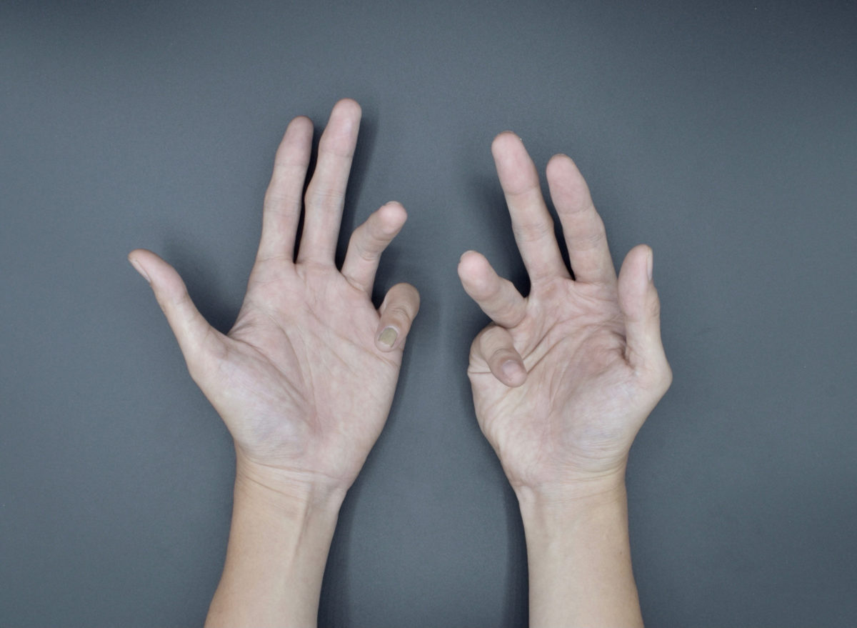 Person with Dupuytren's contracture laying their hands on a gray table with their fingers curled towards their palms.
