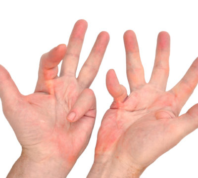 Dupuytren’s Contracture – What it is and how to deal with it