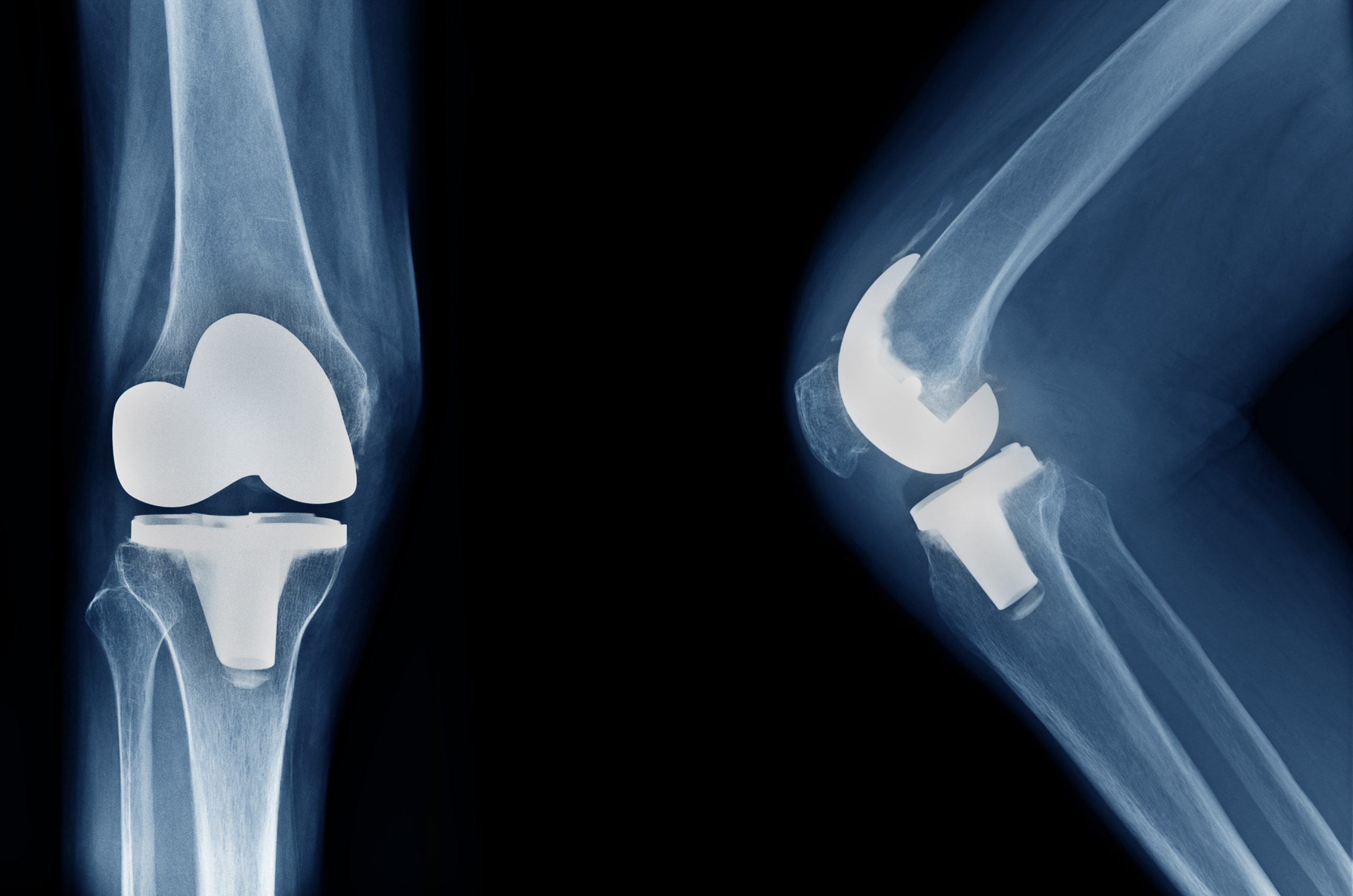 The Benefits of Patient-Specific Alignment Total Knee Arthroplasty