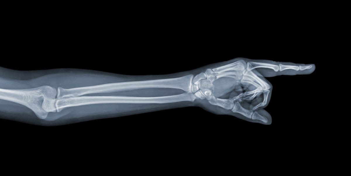  X-ray of hand, arm, and elbow on black background.
