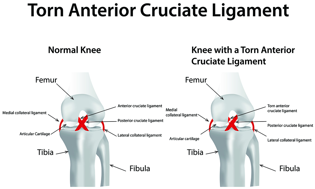 A diagram of a torn ACL 