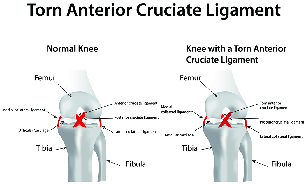 knee-acl-surgery-emergeortho-triangle-region