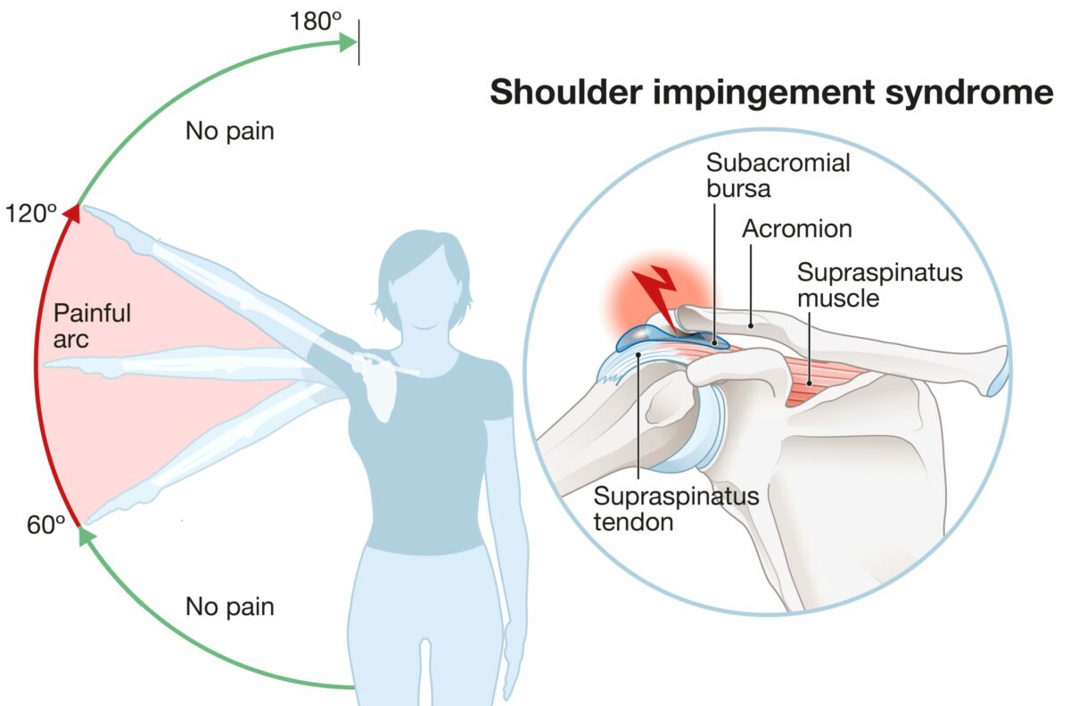 An image of a patient with a shoulder impingement depicting where the pain takes place next to a graphic of a shoulder explaining shoulder impingement syndrome. 