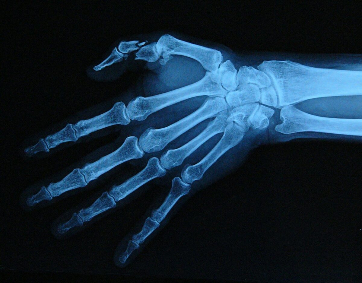 An X-ray image of a patient’s broken thumb.