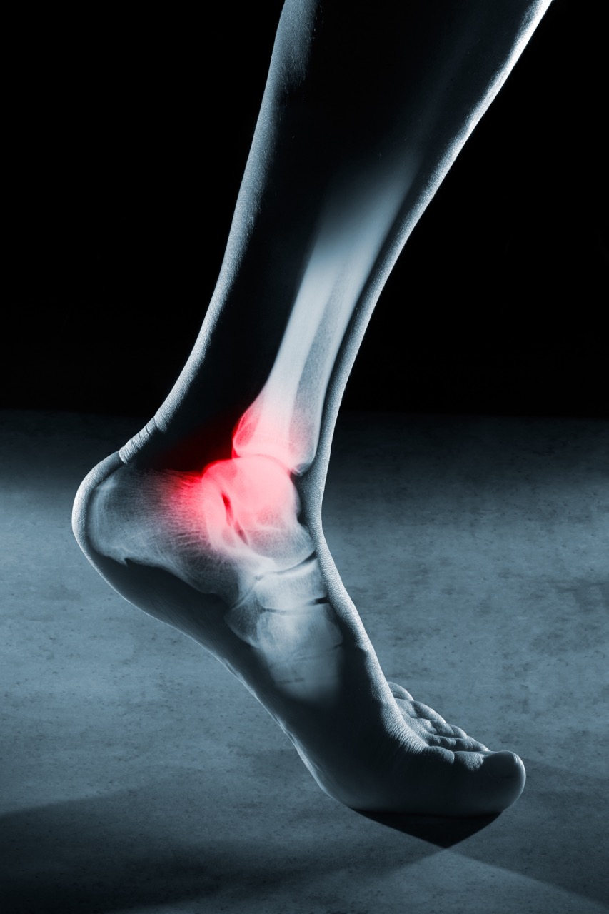 An X-ray of a human foot, with an injured ankle highlighted in red.