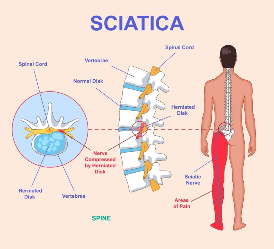 Understanding the Last Stages of Sciatica: Symptoms, Treatment Options, and Recovery