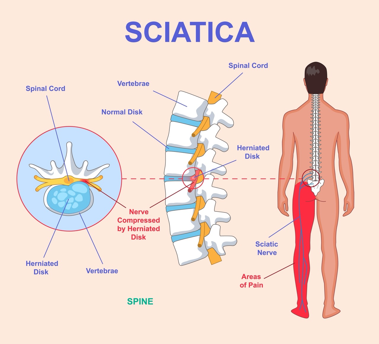 Understanding the Last Stages of Sciatica: Symptoms, Treatment Options, and Recovery